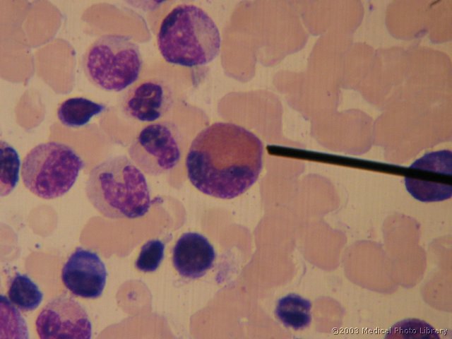 D000 09 Eozinofilni metamielocit.jpg