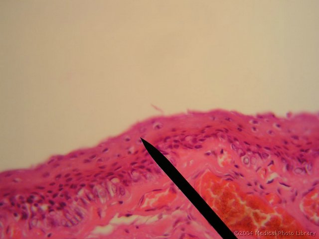 108 06 Vecskladen ploscat epitelij v pravi glasilki.JPG