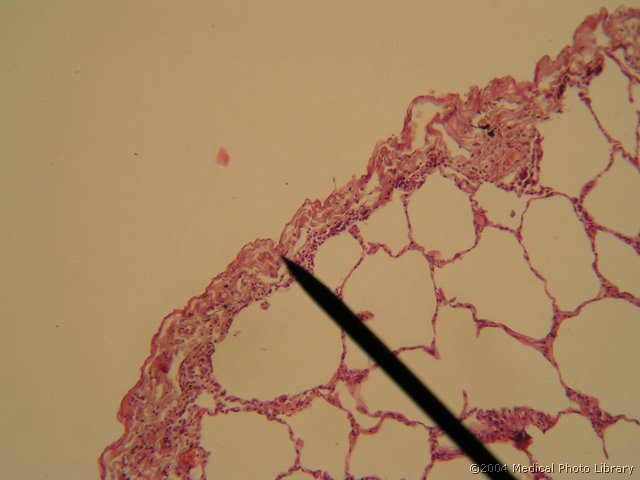 110 07 Visceralni list plevre.JPG