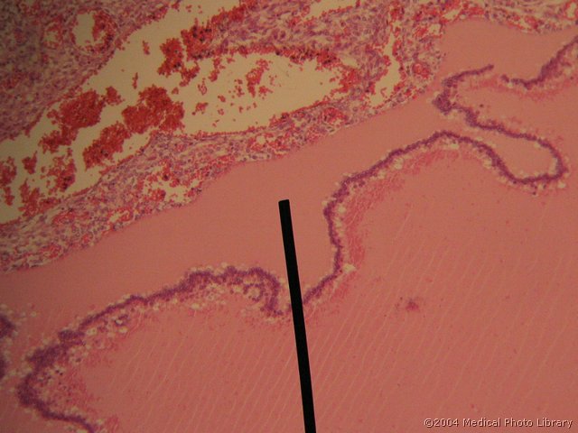 128 09 Atreticni f.jpg