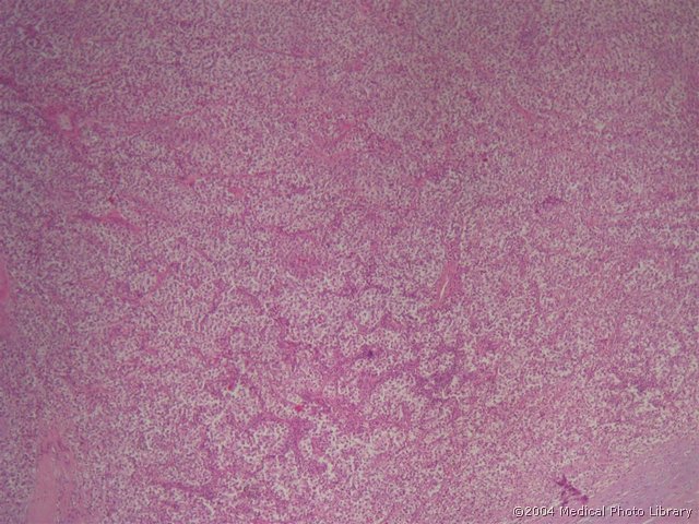 100 1 Seminoma testis.jpg