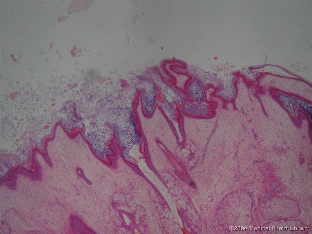 101 1 Teratoma adultum (differentiatum).jpg