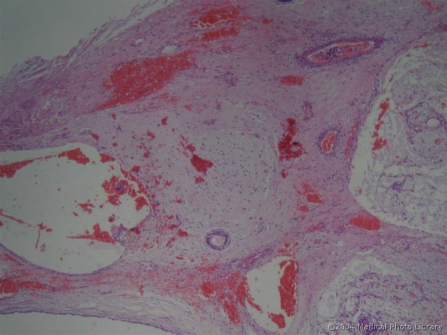 102 1 Teratocarcinoma testis.jpg