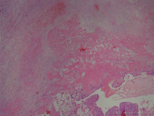 103 1 Choriocarcinoma.jpg