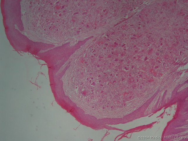 62 1 Epulis gigantocellularis.jpg