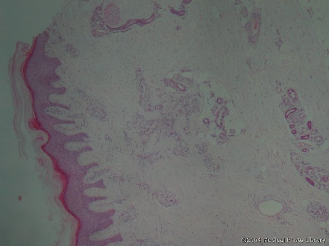 66 1 Histiocytoma fibrosum cutaneum.jpg