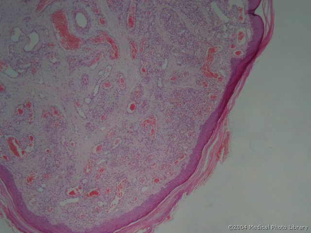 68 1 Haemangioma capillare.jpg