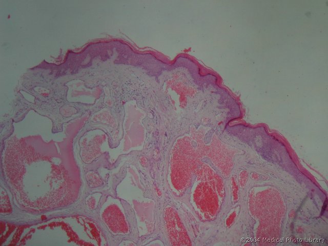 69 1 Haemangioma cavernosum.jpg