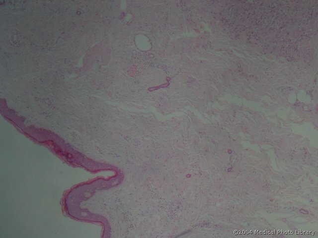 71 1 Histiocytoma fibrosum malignum.jpg
