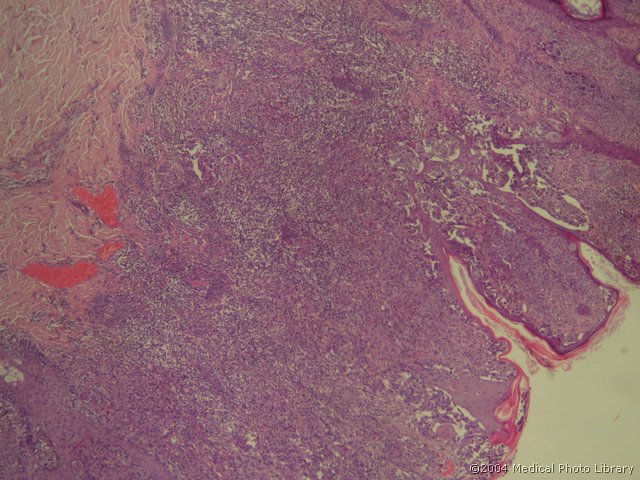78 01 Melanoma malignum.jpg