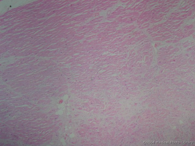 41 1 Pericarditis fibrinosa in organisatione.jpg
