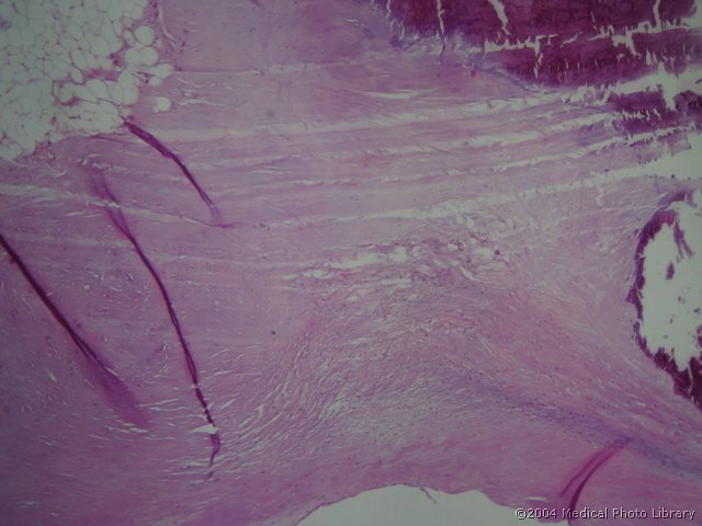 43 1 Endocarditis verrucosa.jpg