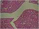 79 01 Adenoma tubulovillosum intestini crassi.jpg