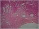 64 1 Leiomyoma.jpg